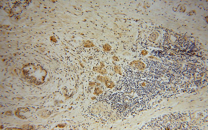 Immunohistochemical of paraffin-embedded human pancreas cancer using Catalog No:117115(BEGAIN antibody) at dilution of 1:50 (under 10x lens)