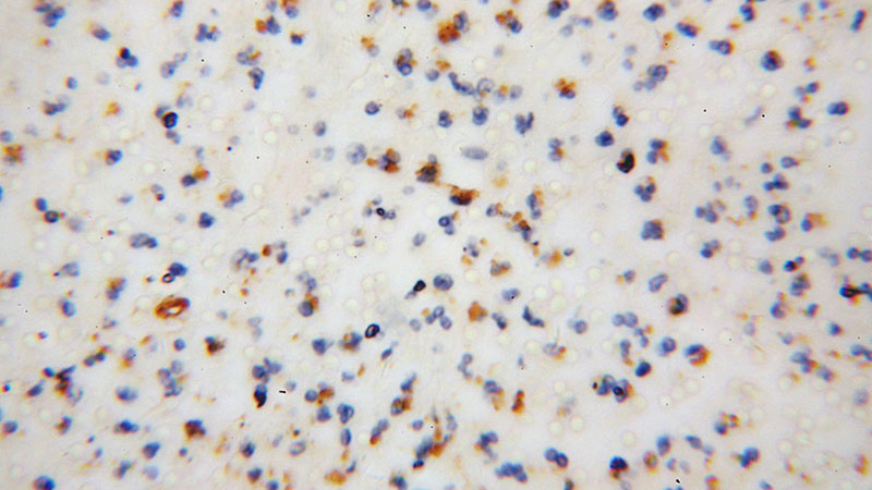 Immunohistochemical of paraffin-embedded human colon cancer using Catalog No:110434(FA2H antibody) at dilution of 1:50 (under 40x lens)