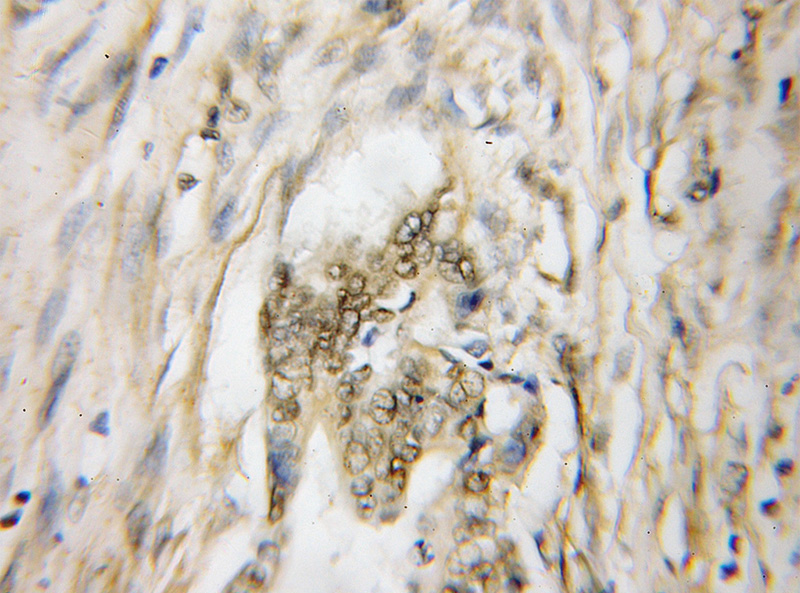 Immunohistochemical of paraffin-embedded human pancreas cancer using Catalog No:112915(MYCBP antibody) at dilution of 1:50 (under 10x lens)