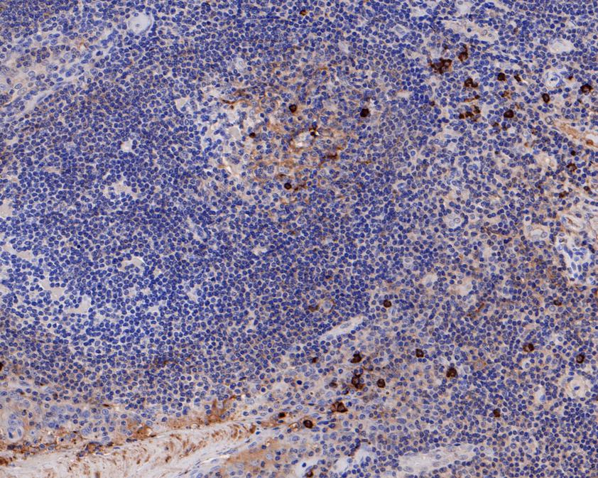 Fig2:; Immunohistochemical analysis of paraffin-embedded human tonsil tissue using anti-IgG4 antibody. The section was pre-treated using heat mediated antigen retrieval with Tris-EDTA buffer (pH 8.0-8.4) for 20 minutes.The tissues were blocked in 5% BSA for 30 minutes at room temperature, washed with ddH; 2; O and PBS, and then probed with the primary antibody ( 1/200) for 30 minutes at room temperature. The detection was performed using an HRP conjugated compact polymer system. DAB was used as the chromogen. Tissues were counterstained with hematoxylin and mounted with DPX.