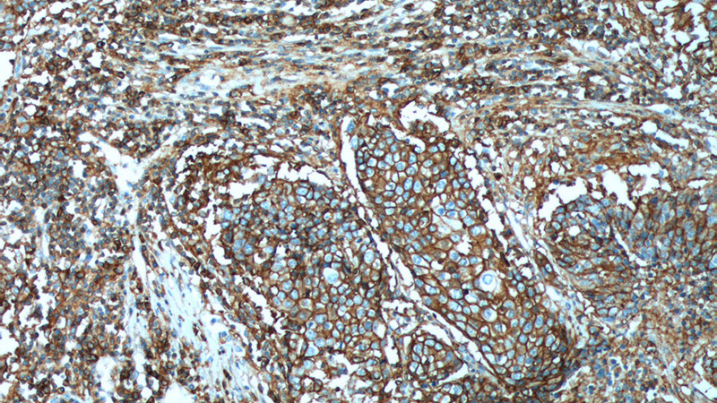 Immunohistochemistry of paraffin-embedded human lung cancer tissue slide using Catalog No:109124(CD44 Antibody) at dilution of 1:200 (under 10x lens). heat mediated antigen retrieved with Tris-EDTA buffer(pH9).