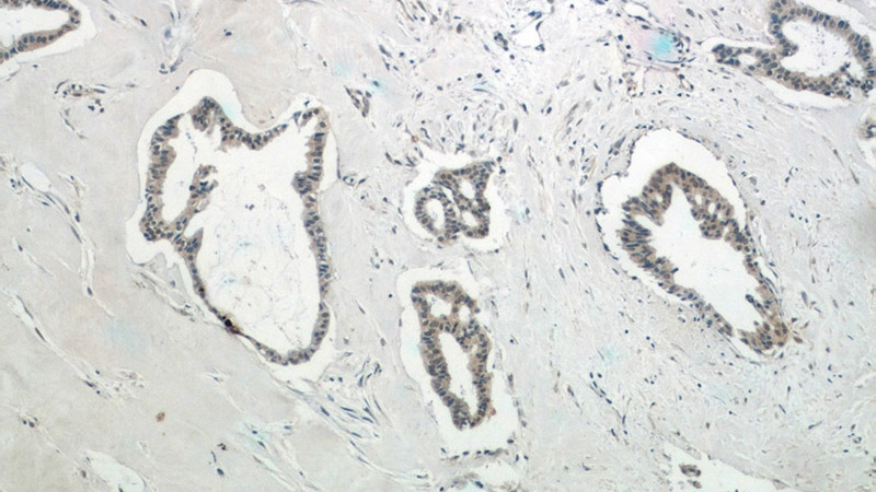 Immunohistochemistry of paraffin-embedded human breast cancer tissue slide using Catalog No:111805(INO80C Antibody) at dilution of 1:50 (under 10x lens)