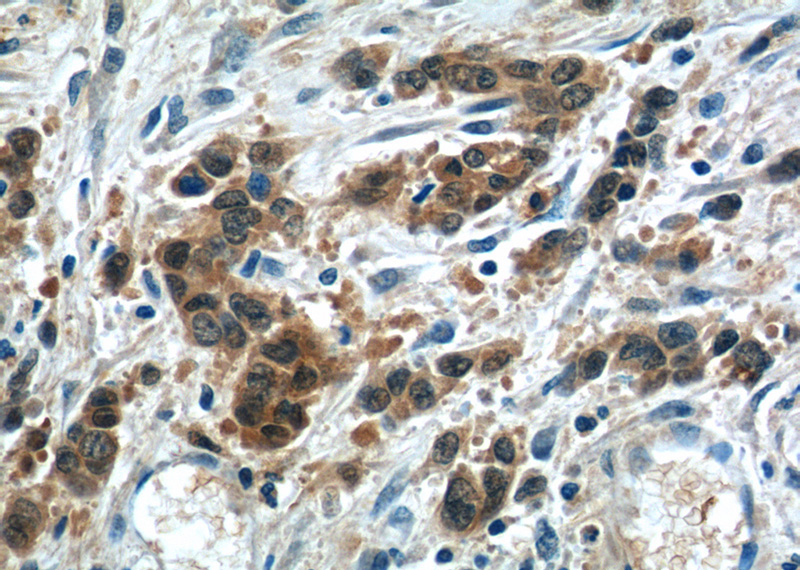 Immunohistochemistry of paraffin-embedded human stomach cancer tissue slide using Catalog No:112330(LRRC20 Antibody) at dilution of 1:50 (under 40x lens)
