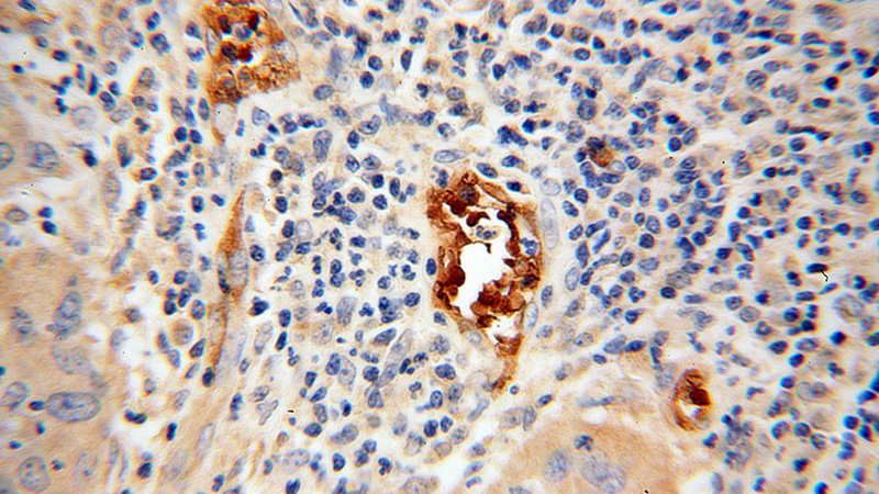 Immunohistochemical of paraffin-embedded human cervical cancer using Catalog No:108403(BACH1 antibody) at dilution of 1:100 (under 40x lens)