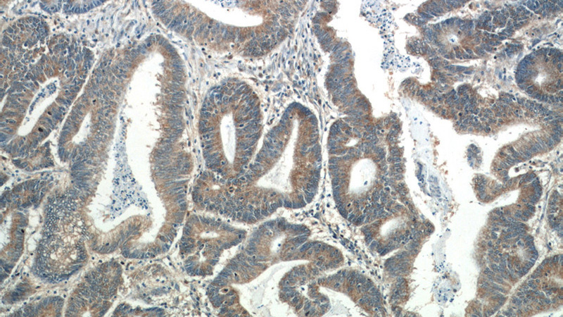 Immunohistochemistry of paraffin-embedded human colon cancer tissue slide using Catalog No:112836(MRPL55 Antibody) at dilution of 1:50 (under 10x lens)