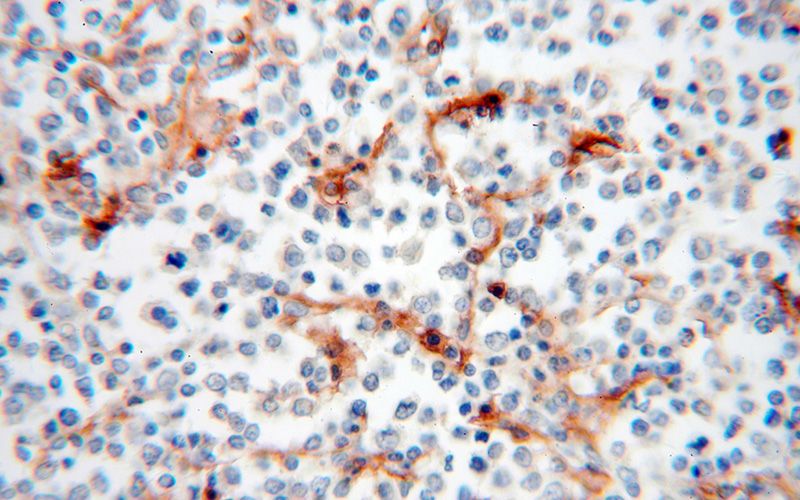 Immunohistochemical of paraffin-embedded human lymphoma using Catalog No:111416(HLA class I (HLA-C) antibody) at dilution of 1:50 (under 40x lens)