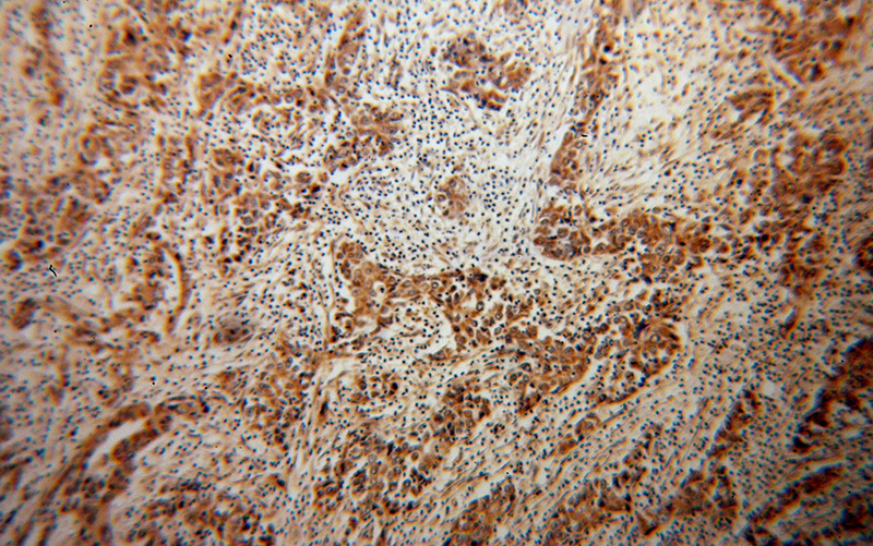Immunohistochemical of paraffin-embedded human pancreas cancer using Catalog No:113301(NOMO2 antibody) at dilution of 1:100 (under 10x lens)