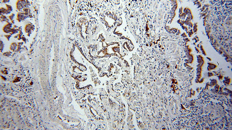 Immunohistochemical of paraffin-embedded human lung cancer using Catalog No:107411(MAGEA3 antibody) at dilution of 1:50 (under 10x lens)