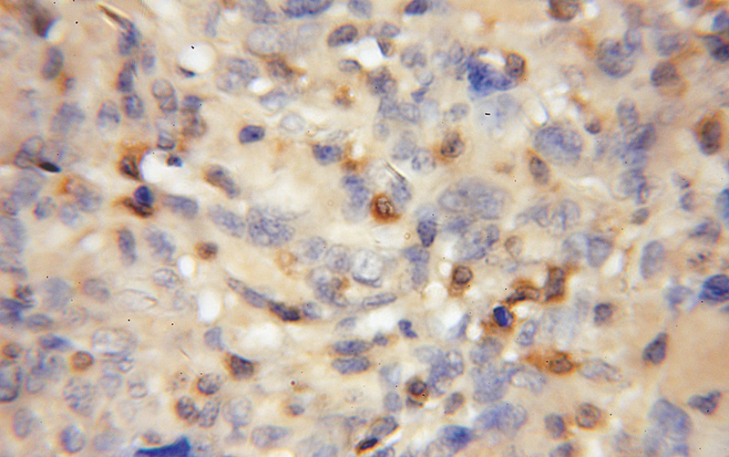 Immunohistochemical of paraffin-embedded human gliomas using Catalog No:113482(PADI2 antibody) at dilution of 1:50 (under 10x lens)