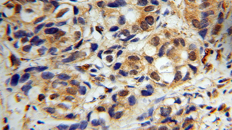 Immunohistochemical of paraffin-embedded human liver cancer using Catalog No:109443(COMMD1 antibody) at dilution of 1:50 (under 40x lens)