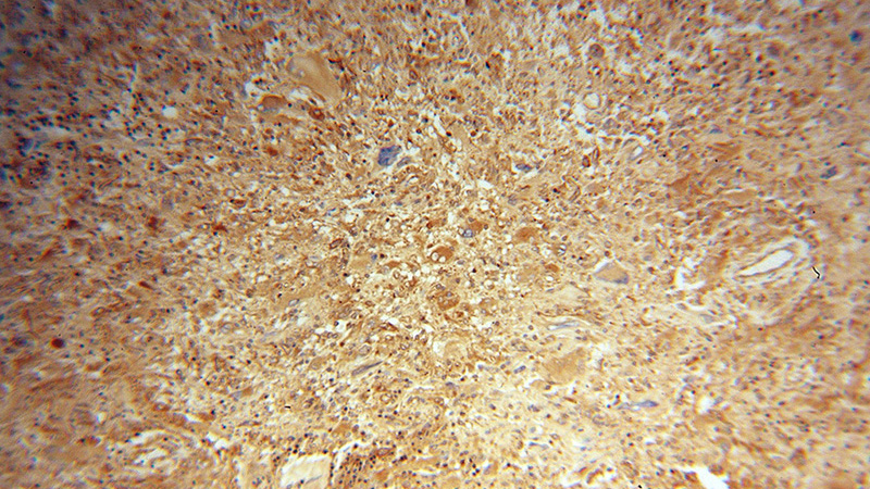 Immunohistochemical of paraffin-embedded human gliomas using Catalog No:110133(dynactin-2 antibody) at dilution of 1:50 (under 10x lens)