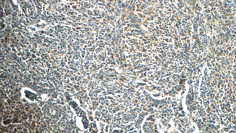 Immunohistochemistry of paraffin-embedded human lymphoma tissue slide using Catalog No:112623(MINK1 Antibody) at dilution of 1:50 (under 10x lens)