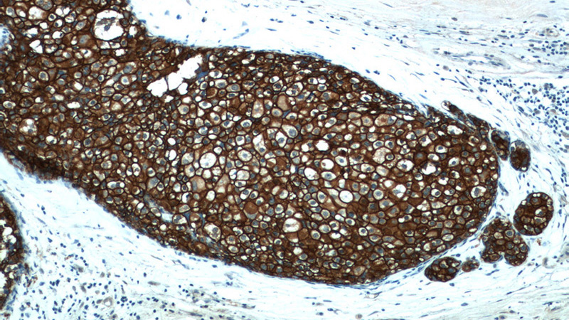 Immunohistochemistry of paraffin-embedded human breast cancer tissue slide using Catalog No:107260(ERBB2 Antibody) at dilution of 1:200 (under 10x lens)