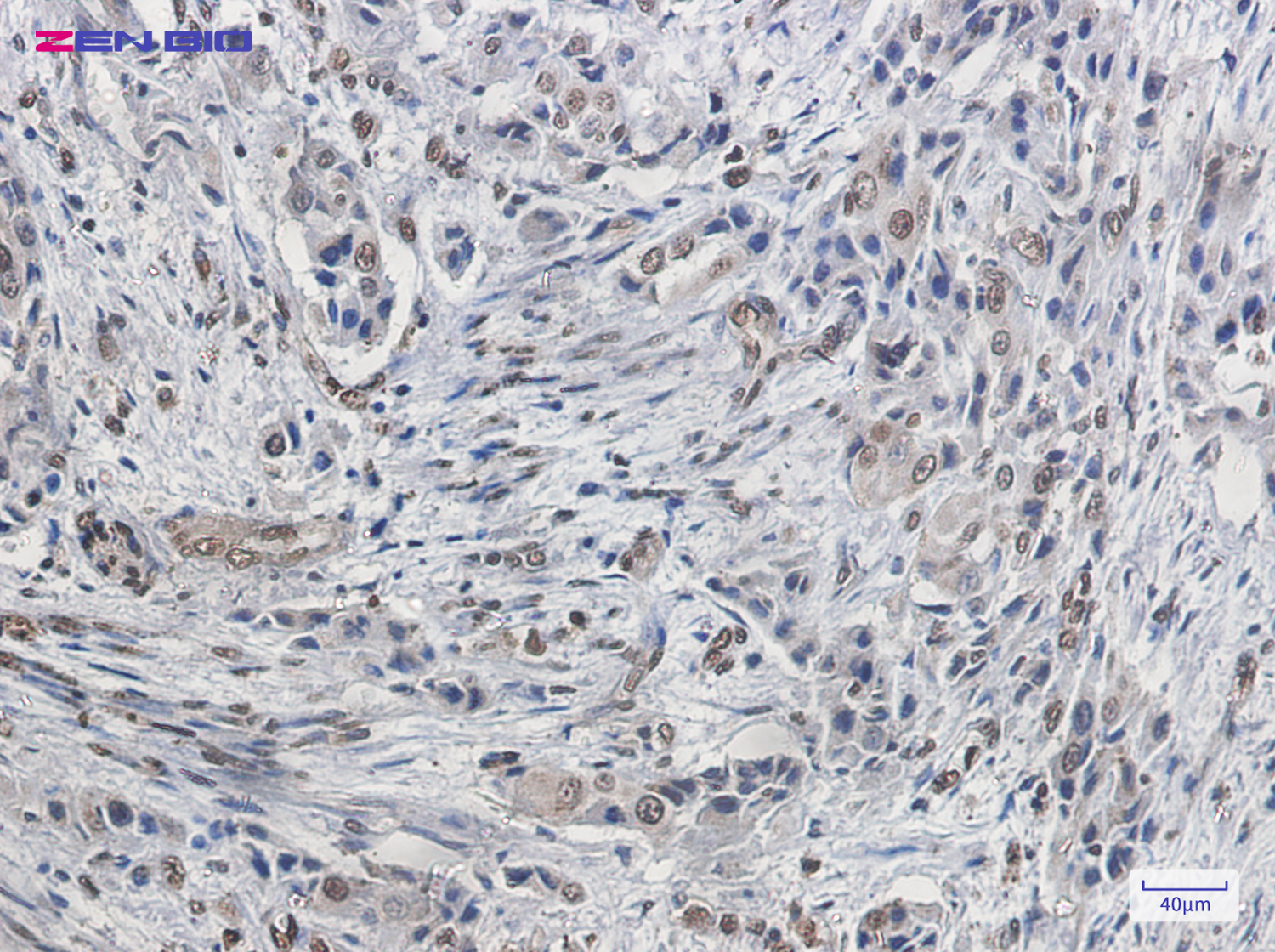 Immunohistochemistry of FBP1 in paraffin-embedded Human lung cancer tissue using FBP1 Rabbit pAb at dilution 1/20