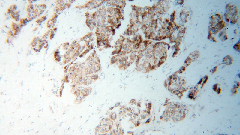 Immunohistochemical of paraffin-embedded human liver cancer using Catalog No:116639(UQCRQ antibody) at dilution of 1:100 (under 10x lens)