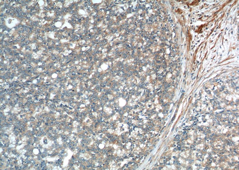 Immunohistochemistry of paraffin-embedded human prostate cancer tissue slide using Catalog No:107357(JNK Antibody) at dilution of 1:200 (under 10x lens).