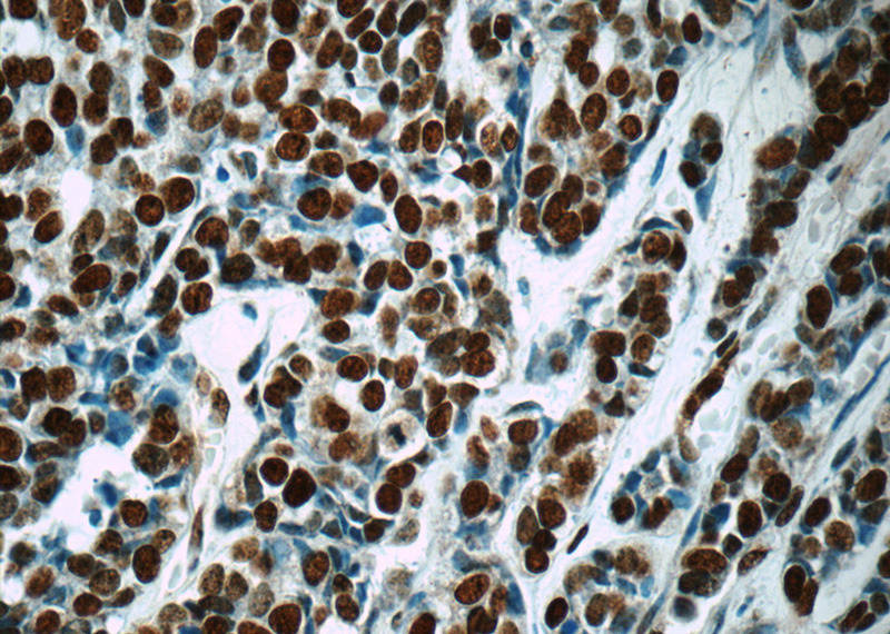 Immunohistochemistry of paraffin-embedded human cervical cancer tissue slide using Catalog No:110220(EGR1 Antibody) at dilution of 1:50 (under 40x lens)