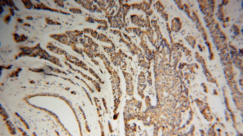 Immunohistochemical of paraffin-embedded human breast cancer using Catalog No:109659(CYC1 antibody) at dilution of 1:100 (under 10x lens)