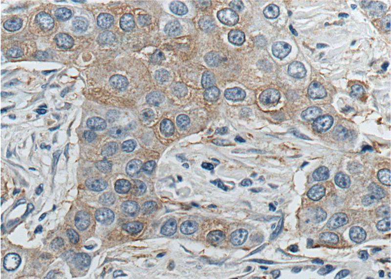 Immunohistochemistry of paraffin-embedded human breast cancer tissue slide using Catalog No:112010(KIF2A Antibody) at dilution of 1:200 (under 40x lens).