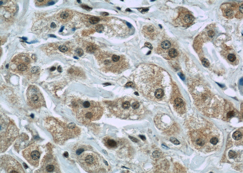Immunohistochemistry of paraffin-embedded human breast cancer slide using Catalog No:110512(FAM98B Antibody) at dilution of 1:50
