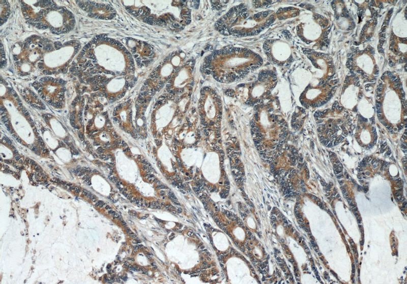Immunohistochemical of paraffin-embedded human colon cancer using Catalog No:113754(PCSK9 antibody) at dilution of 1:50 (under 10x lens)