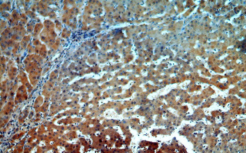 Immunohistochemical of paraffin-embedded human hepatocirrhosis using Catalog No:107880(ALPK1 antibody) at dilution of 1:50 (under 10x lens)