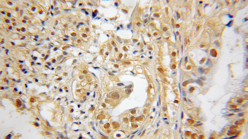 Immunohistochemical of paraffin-embedded human pancreas cancer using Catalog No:115485(SNX7 antibody) at dilution of 1:50 (under 10x lens)