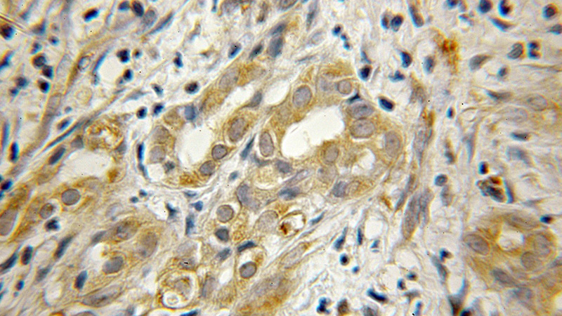 Immunohistochemical of paraffin-embedded human pancreas cancer using Catalog No:110313(EEF1B2 antibody) at dilution of 1:50 (under 10x lens)