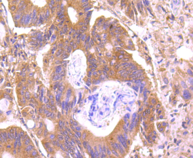 Fig4: Immunohistochemical analysis of paraffin-embedded human colon cancer tissue using anti-C14orf93 antibody. Counter stained with hematoxylin.