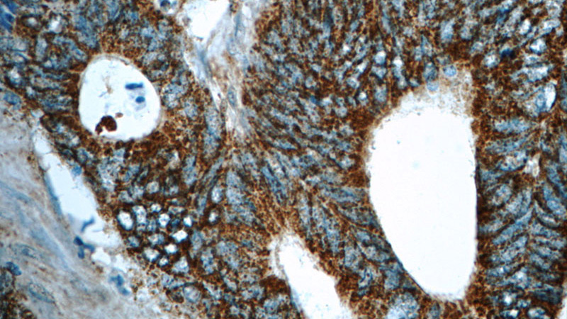 Immunohistochemistry of paraffin-embedded human colon cancer tissue slide using Catalog No:112864(MS4A12 Antibody) at dilution of 1:50