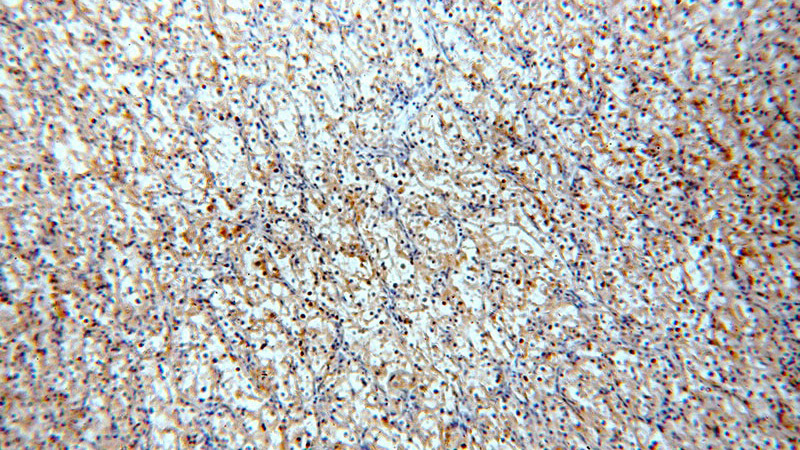 Immunohistochemical of paraffin-embedded human renal cell carcinoma using Catalog No:107427(MME,CD10 antibody) at dilution of 1:100 (under 10x lens)