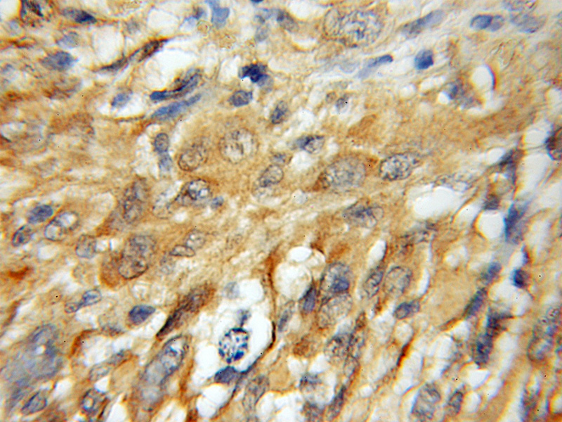 Immunohistochemical of paraffin-embedded human gliomas using Catalog No:109763(DCUN1D1 antibody) at dilution of 1:50 (under 10x lens)