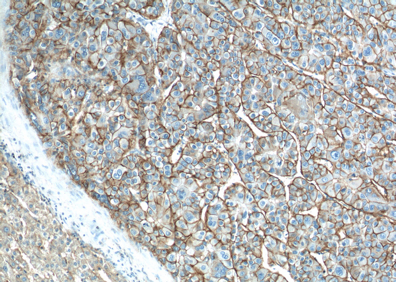 Immunohistochemistry of paraffin-embedded human liver cancer tissue slide using Catalog No:117301(ATP1A1 Antibody) at dilution of 1:200 (under 10x lens)