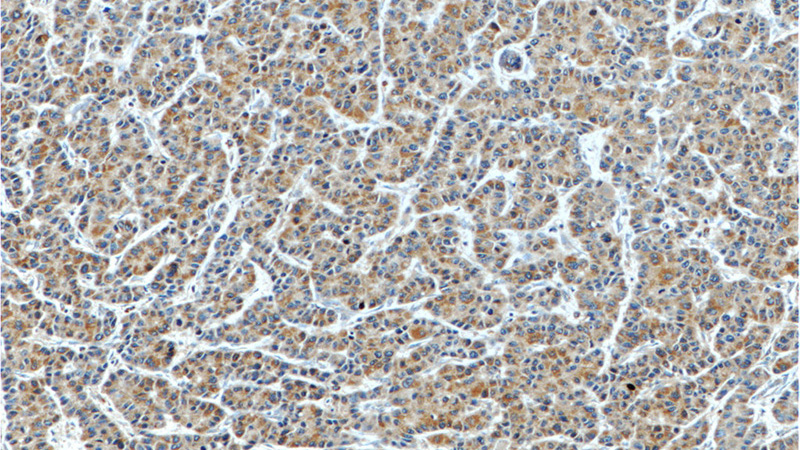 Immunohistochemistry of paraffin-embedded human liver cancer tissue slide using Catalog No:117197(BMP3 Antibody) at dilution of 1:50 (under 10x lens)