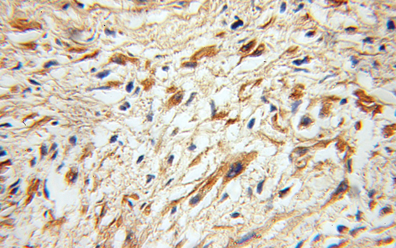 Immunohistochemical of paraffin-embedded human gliomas using Catalog No:107979(ALG1 antibody) at dilution of 1:100 (under 10x lens)