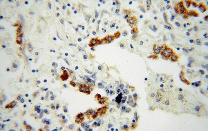 Immunohistochemical of paraffin-embedded human lung cancer using Catalog No:110728(FMO2 antibody) at dilution of 1:100 (under 40x lens)