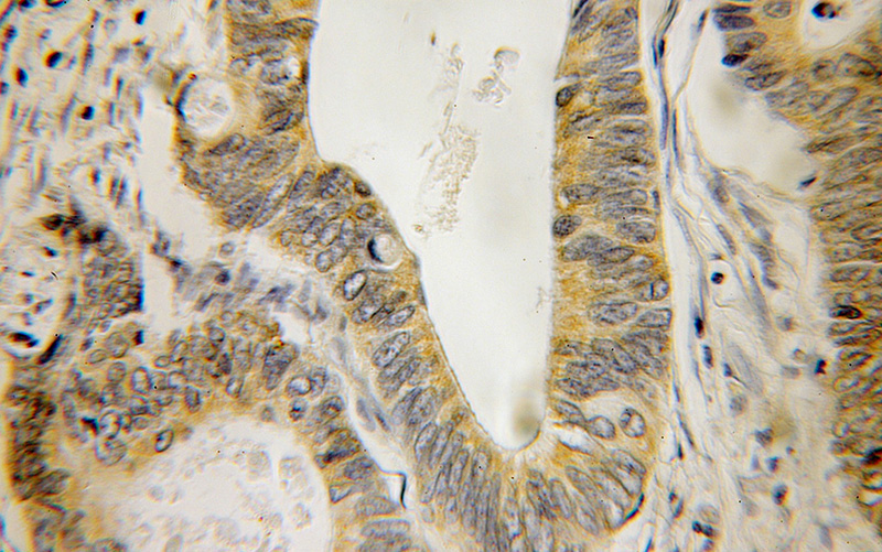 Immunohistochemical of paraffin-embedded human colon cancer using Catalog No:112241(LIPA antibody) at dilution of 1:100 (under 10x lens)
