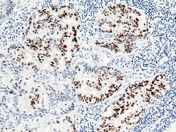 p53 / TP53 Antibody, Rabbit MAb, Immunohistochemistry