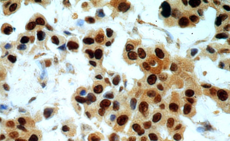 Immunohistochemical of paraffin-embedded human breast cancer using Catalog No:117336(PCNA antibody) at dilution of 1:50 (under 40x lens)