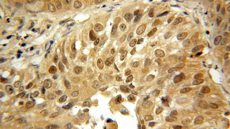 Immunohistochemical of paraffin-embedded human lung cancer using Catalog No:113861(PK-M2-specific antibody) at dilution of 1:100 (under 40x lens)