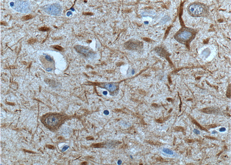 Immunohistochemistry of paraffin-embedded human brain tissue slide using Catalog No:113163(NEFM-Specific Antibody) at dilution of 1:200 (under 40x lens).