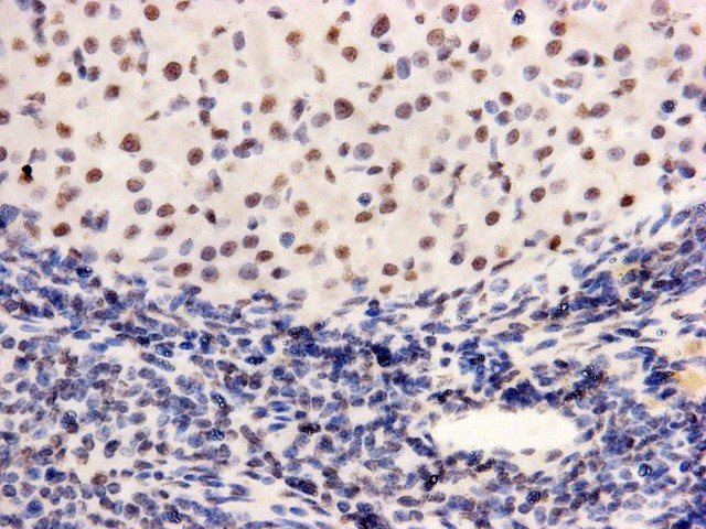 Fig3: Immunohistochemical analysis of paraffin- embedded human lung cancer tissue using anti-PGBD5 Mouse mAb (Cat. # 176652#).