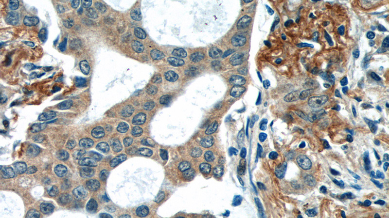 Immunohistochemistry of paraffin-embedded human lung cancer tissue slide using Catalog No:116836(WNT5A-B Antibody) at dilution of 1:50 (under 40x lens)