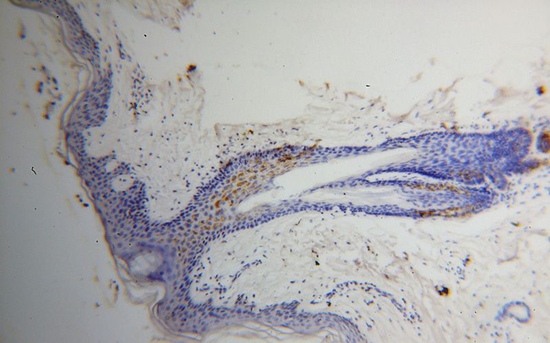 Immunohistochemical of paraffin-embedded human skin cancer using Catalog No:114952(S100B antibody) at dilution of 1:100 (under 10x lens)