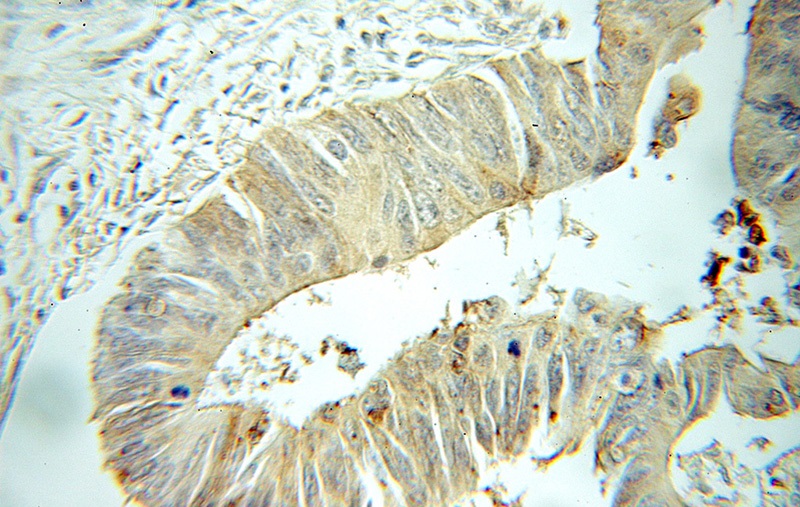 Immunohistochemical of paraffin-embedded human colon cancer using Catalog No:116132(TIMM17B antibody) at dilution of 1:50 (under 10x lens)