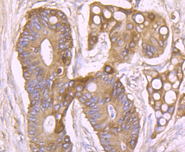 Fig3: Immunohistochemical analysis of paraffin-embedded human colon cancer tissue using anti-NaV1.7 antibody. Counter stained with hematoxylin.