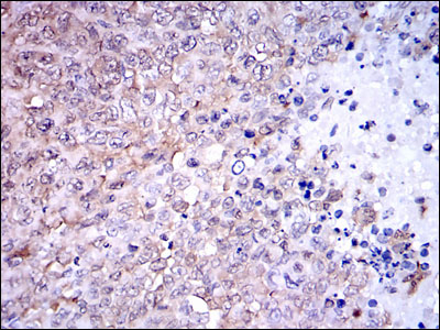 Immunohistochemical analysis of paraffin-embedded ovarian cancer tissues using NQO1 mouse mAb with DAB staining.
