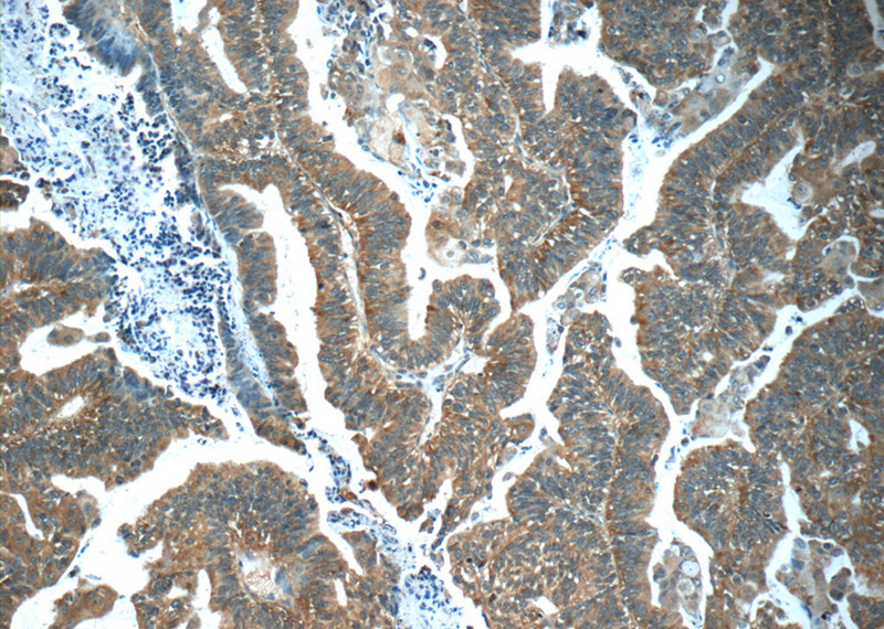 Immunohistochemistry of paraffin-embedded human ovary tumor tissue slide using Catalog No:116189(TMEM5 Antibody) at dilution of 1:50 (under 10x lens)