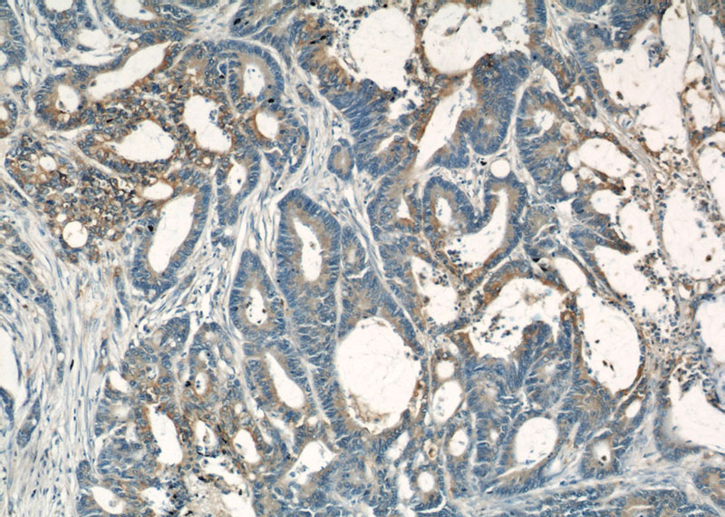 Immunohistochemical of paraffin-embedded human colon cancer using Catalog No:113859(PKM antibody) at dilution of 1:50 (under 10x lens)