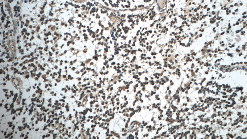 Immunohistochemistry of paraffin-embedded human gliomas tissue slide using Catalog No:110826(GAGE7 Antibody) at dilution of 1:50 (under 10x lens)